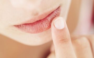 home-remedies-for-chapped-lips-722x406