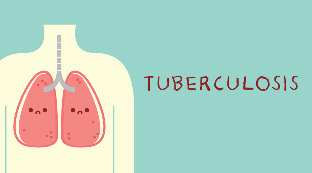 Kementerian Kesehatan (Kemenkes) berencana melakukan skrining penyakit tuberculosis (TBC) secara besar-besaran di Indonesia.